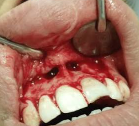 Apicectomy
